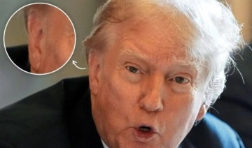 Trump'ın bandajsız ilk fotoğrafı tartışma yarattı